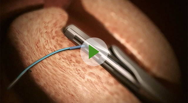 ウロリフト（UroLift）｜足利市の泌尿器科・内科・皮膚科 なかたクリニック